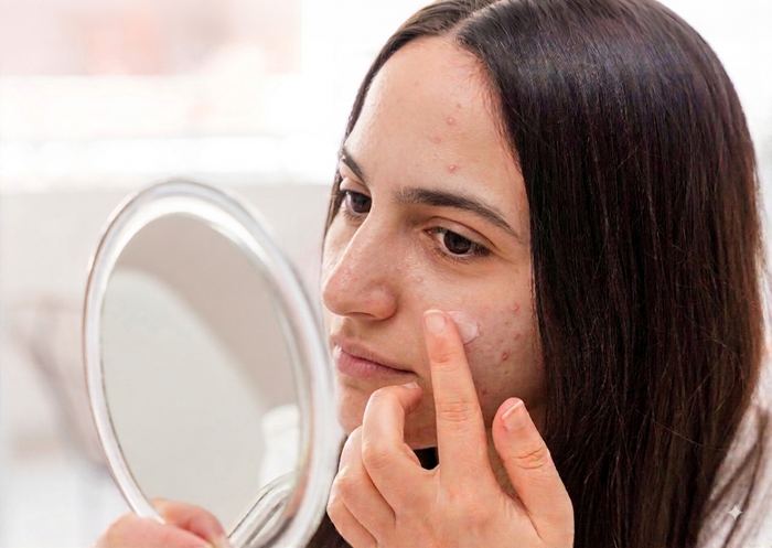Do Oily and Acne-Prone Skin Types Really Need a Moisturiser?