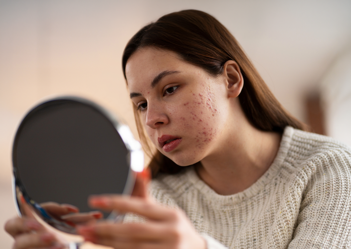 Tired of Breakouts? Your Complete Daily Skincare Routine for Acne-Prone Skin (Morning & Night)